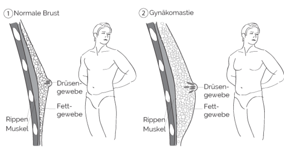 Gynäkomastie, prevention-center für Schönheitschirurgie in Zug, Dr. Christian Köhler